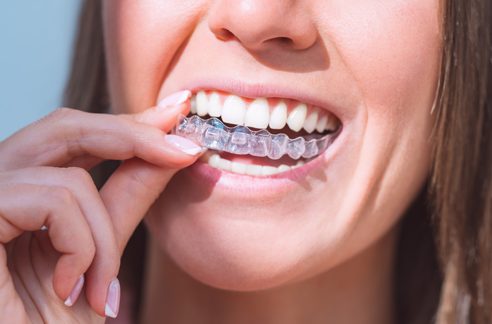 What You Need to Know About Your Aligners