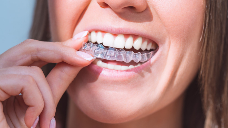 What You Need to Know About Your Aligners