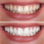 Teeth Whitening vs. DIY Solutions: Why You Should Choose Professional Treatment