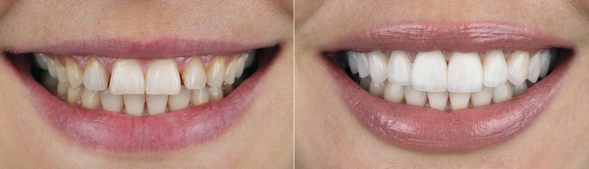 How Veneers Can Fix Common Dental Imperfections