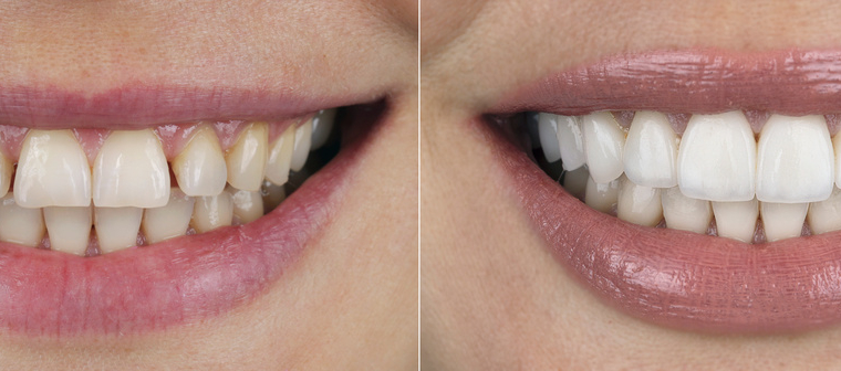 How Veneers Can Fix Common Dental Imperfections