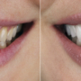 How Veneers Can Fix Common Dental Imperfections